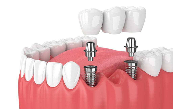 Best Dental Care in Keelkattalai